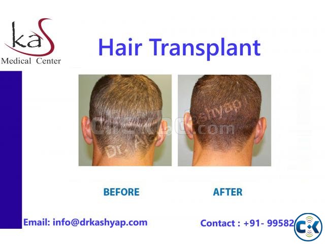 KAS Medical Center Delhi for All Your Hair Transplant Needs large image 0